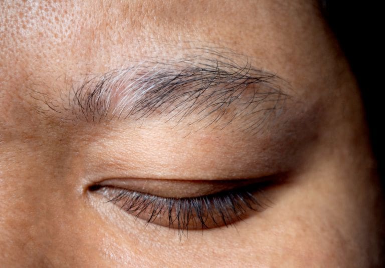 Patchy Eyebrows Treatment London