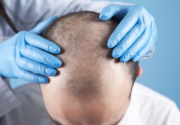 Is A Hair Transplant Permanent? AHI Clinic London